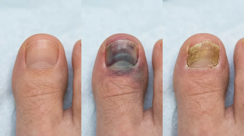 Bruised Toenail vs Fungus Full Comparison